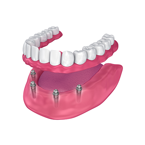 Overdenture to be seated on implants - ball attachments. 3D illustration